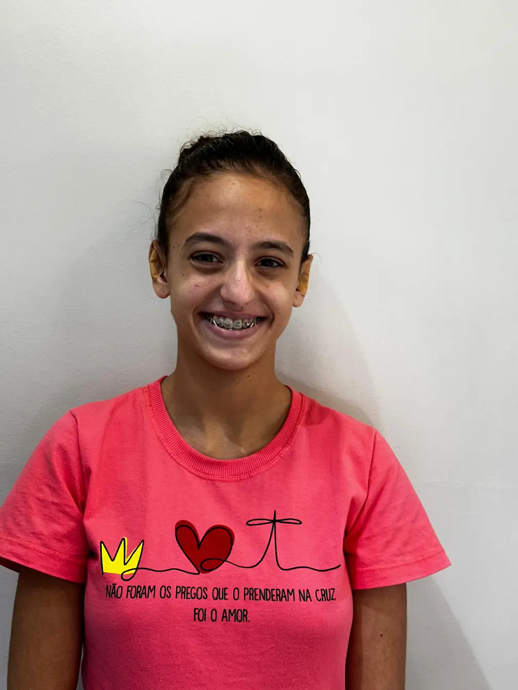 Transformação com Método EarLine - Correção definitiva de orelhas proeminentes, procedimento realizado em 2 horas